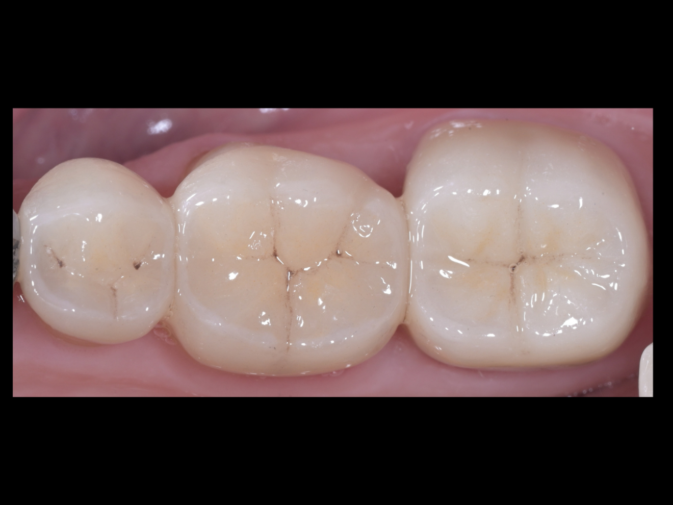 Inlays Onlays Junaid Saleem Malik Dentist In London 2 